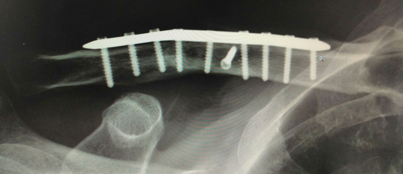 clavicola